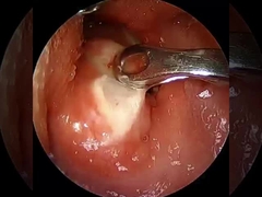 Hiện tại ≤1.5mA Xét xương khớp RF Plasma Wand Thiết bị phẫu thuật Vai Đùi Đầu gối