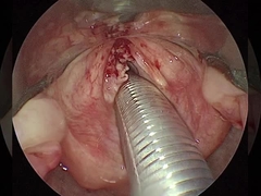 Hiện tại ≤1.5mA Xét xương khớp RF Plasma Wand Thiết bị phẫu thuật Vai Đùi Đầu gối